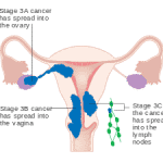 Cervical Cancer | You Will Stick to One Partner After Reading This Post