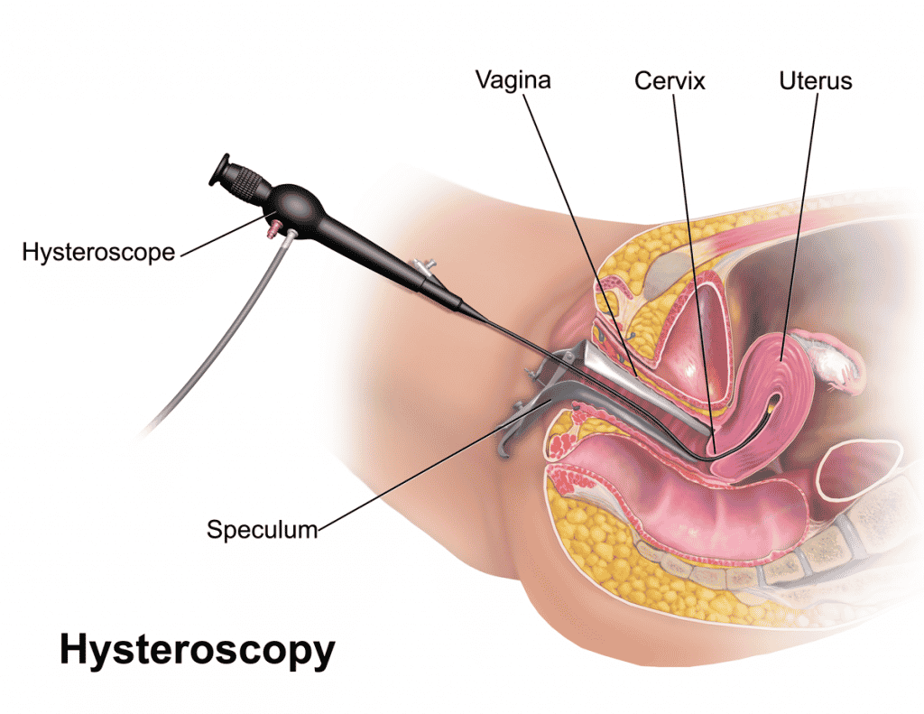 Cervical Cancer Biopsy 